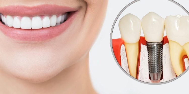 Oral care dental implant